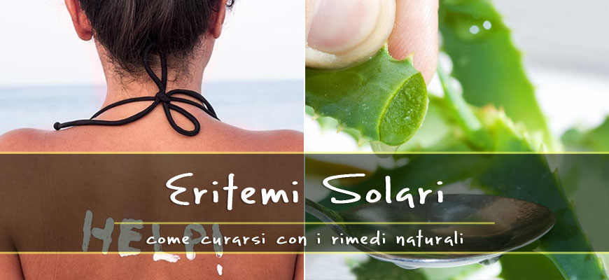 solar erythema natural remedies